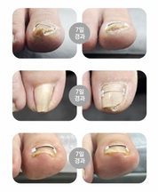 DGEL CORRECTOR - for ingrown nails