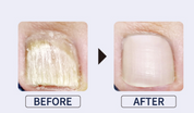 IZEMI Vanish FS one drop - anti fungal treatment