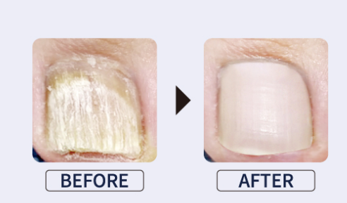 Vanish FS one drop - anti fungal treatment