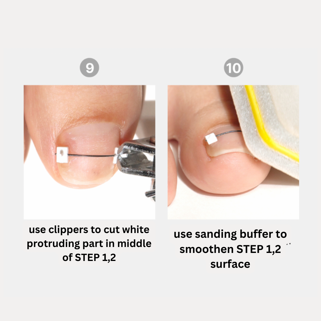 DGEL CORRECTOR - for ingrown nails