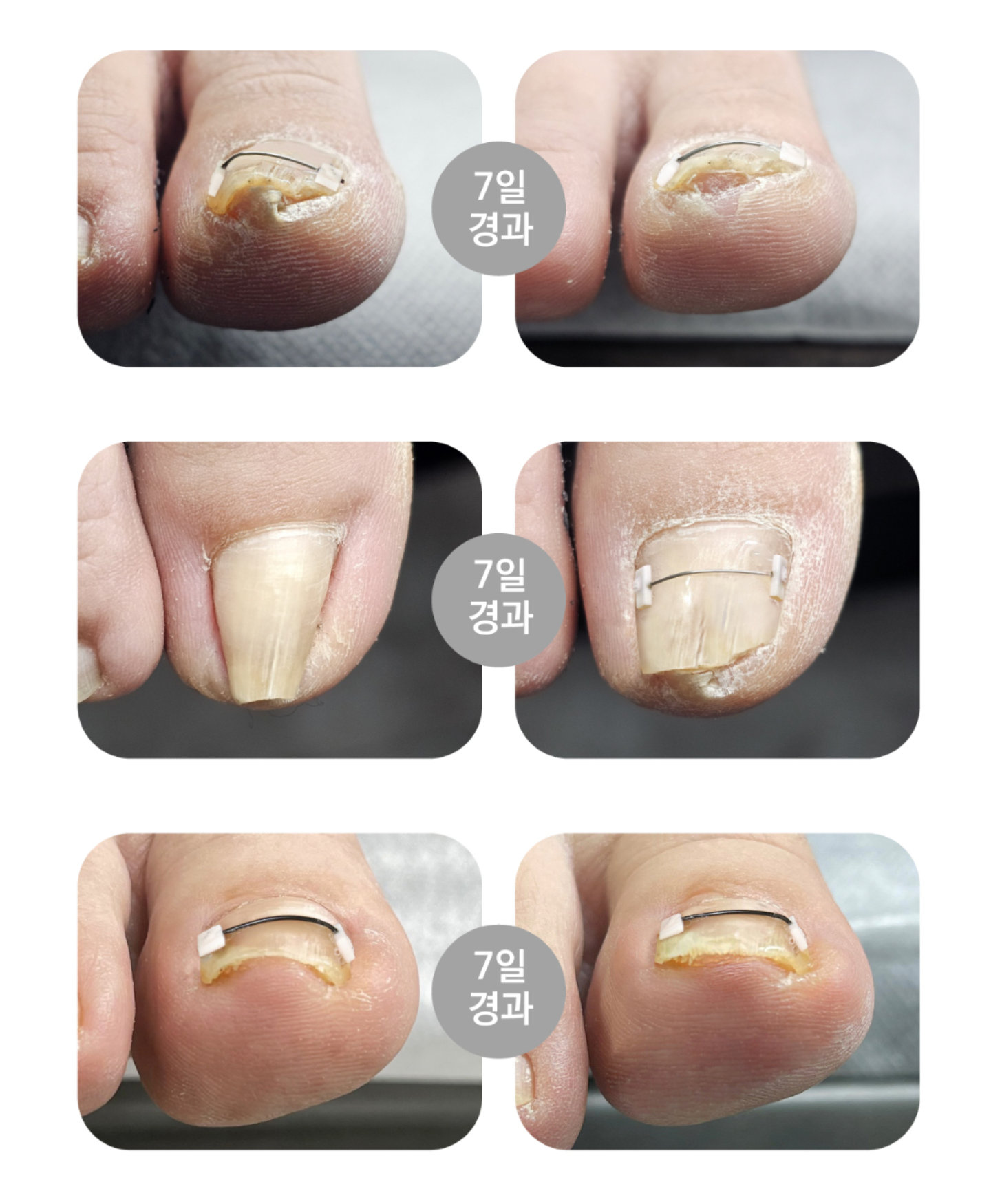 DGEL CORRECTOR - for ingrown nails