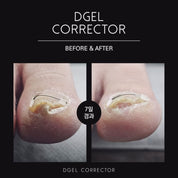 DGEL CORRECTOR - for ingrown nails